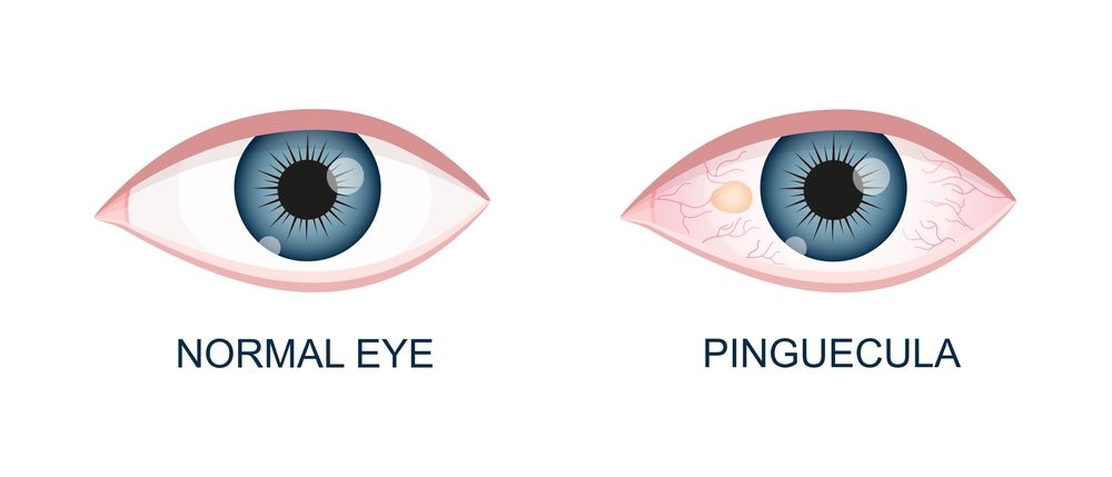 how-does-a-pinguecula-look